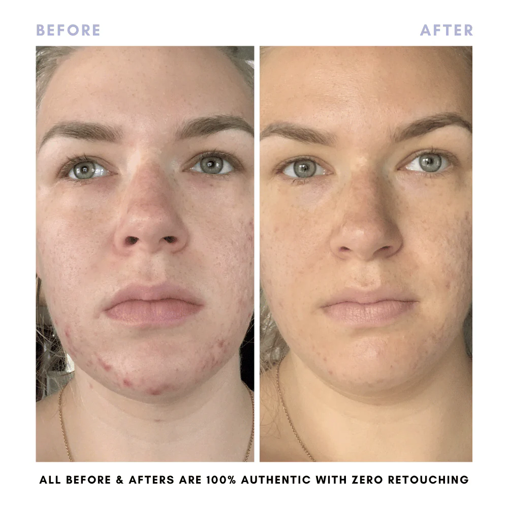 BUNDLE & SAVE! The Balanced Skin Set - Image 11